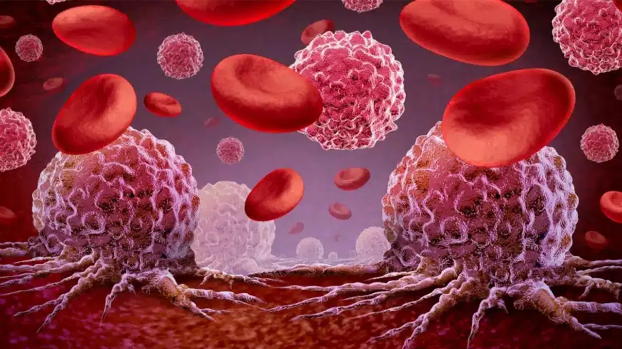 lenfoma erken teshisle buyuk oranda tedavi edilebiliyor xmHB9jcz